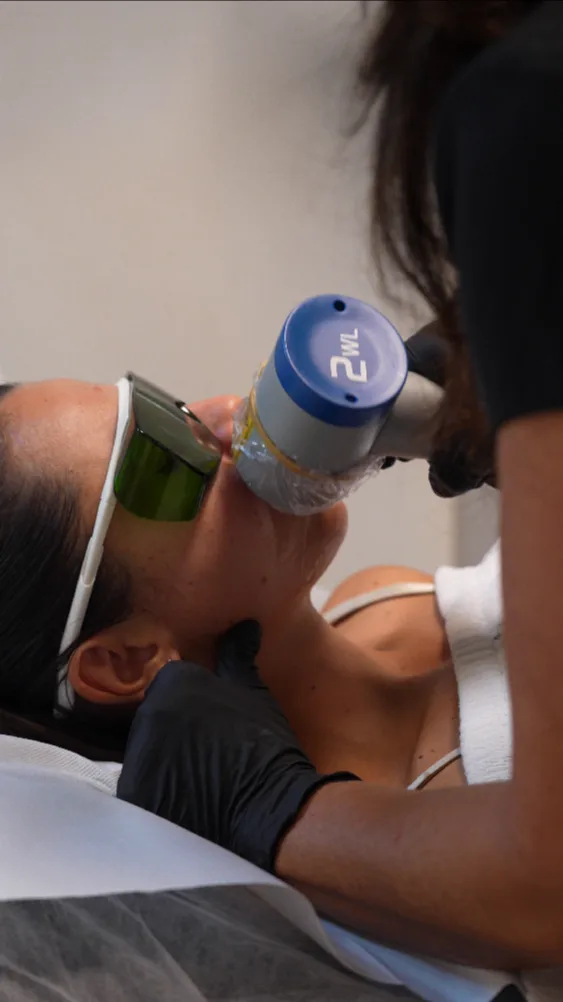 Epilazione laser viso con laser a diodo - Aestetica Salvati Napoli
